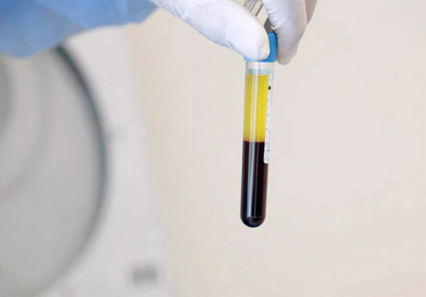 Tubo de PRGF-Endoret tras el centrifugado, con el plasma rico en plaquetas separado