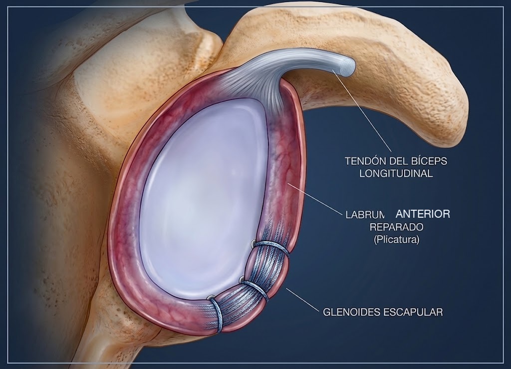 Reparación artroscópica del labrum anterior